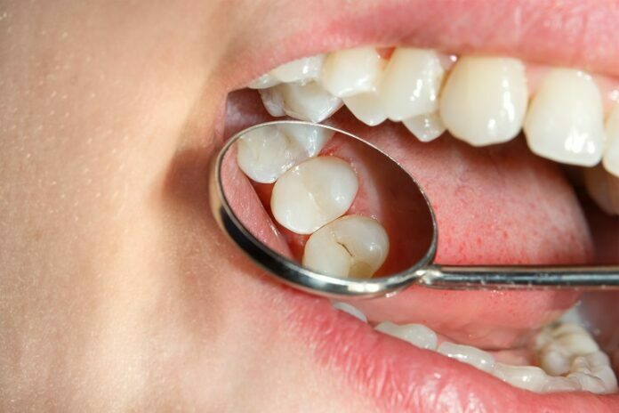 Prevent Cavities